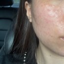 아이디병원 | 피부 속까지 탄탄하게! 동탄 아이디 의원에서 리쥬베룩 시술 받고 왔어요