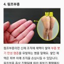 손가락 주름 무시하면 안되는 질환 6가지 이미지