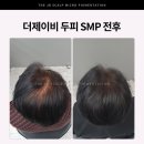 더제이비(THEJB) | 60대 여성 정수리 탈모, 두피 SMP로 자연스럽게 커버한 후기 [대구 더제이비]