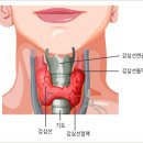 더위 체질 호르몬 갑상선 기능항진증은 ... 이미지