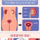 방광 결석 원인 진단 예방 방광결절 제거술 이미지