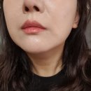 인샤인 | 인샤인피부과 쿨소닉 8000샷 통증/가격/상담/시술 후기