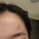 국홍일국정표피부과의원 | [블챌] 나의 얼굴 대상포진 이야기 (feat.국홍일국정표 피부과의원)