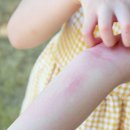 땀띠엔 파우더? 잘못 바르면 세균 번식 위험↑ 이미지