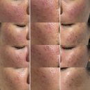 신생한의원 | 울산 한의원 트러블흉터 2회차 치료후기