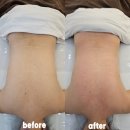 화성드림파크 여성구장 | 대구화주테라피 렛미인 붓기 빠진 동천동피부관리후기 | 몸에 불 붙였어요