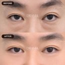 30대 남자 눈밑지우개 수술 후기 | 탄력을 더하는 눈밑, 드라마성형외과
