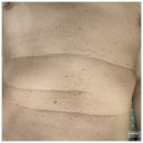 경희가족사랑한의원 | '경희 여우 한의원'에서 밝힌 몸에 생긴 검은 반점! 지루성 각화증 레이저 제거 솔직한 과정