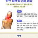 디스크가 아니어도 나타나는 등통증의 다양한 원인들 이미지