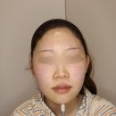 아카이브청담의원 | 쥬베룩볼륨 3번 맞은 후기