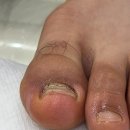 레푸스인하대역점 내성발톱 무좀발톱 발각질 문제성발 이미지