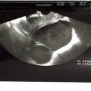 [자작] 난소 혹을 떼어낸 내가.. 알고보니 자궁내막증에 자궁내막증식증까지 있는 환자였다고?(긴 글 주의) 이미지