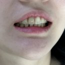 이편한장치과의원 | 2d치과 블랙필름 가격부터 상담, 시술까지 내돈내산 후기