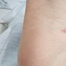 레푸스 구월점 내성발톱 무좀발톱 발각질 문제성발 이미지