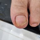 루덴네일 | 60대 무좀발톱 고객님의 감동 송파 루덴풋케어 방문후기