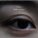 삼겹무쌍 | 비절개눈매교정 후기 : 삼겹쌍꺼풀을 한 겹으로