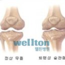 [관절내시경] 퇴행성 관절염도 증상에 따라서 관절내시경으로 치료해요 이미지