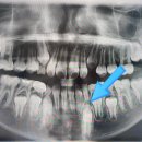 닥터오치과의원 | 교정치료 중 발견한 자녀 과잉치, 창원 닥터오치과에서 발치 수술