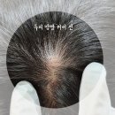줄리아뷰티 - 북구 도남길 16 | 남자 두피문신 땜빵, 어떻게 해결할까? 줄리아뷰티 남자 두피 흉터 땜빵 SMP 후기