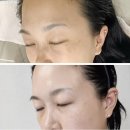 센텀피부과 기미색소컨택터에 기미레이저토닝까지! 두가지를 함께하니 더 효과가 좋은 센텀기미치료