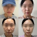 황금역 | 대구 수성구 황금역 피부과 텐써마 후기 (고현정리프팅, 티타늄리프팅 차이)