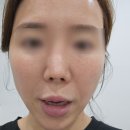 아이리쥬란풀페이스 얼굴 광이 대박 청담리쥬란 튠의원 리쥬란후기