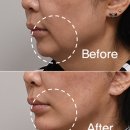 닥터정앤박날씬의원 | 안면거상술, 심부볼지방제거 효과까지 낼 수 있습니다. (+후기, 비용)