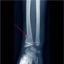 D00571 | 골절Fractures 개요