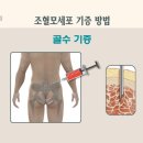 골수이식 척추뼈에서 뽑는거 아냐? 엄청 아프다던데ㅠㅠ ☜아님!!! 이미지