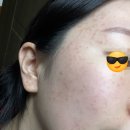 수원 편평사마귀 제거 당일, 주의사항 - 분당 미금역 편사 성지 유어라인의원