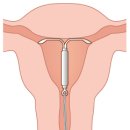 성모샘정신건강의학과의원 | [엄마일기] CA125 난소암 표지자 초과가 자궁선근증이었던 것에 대하여