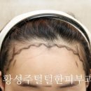 선헤어라인 이미지