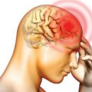 뇌졸증(중풍,치매)의 전조 증상. 이미지