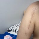 매듭병원 | 팔 골절 수술 + 핀 제거 후기 - 매듭 병원 김경환 원장님