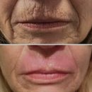 보톡스, 필러는 이제 그만하세요!!!Fibroblast Treatment 으로 다 해결됩니다~ 이미지