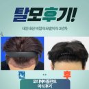 모디헤어플란트의원 | 모디헤어플란트 남자 m자 모발이식 2주년 솔직후기
