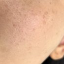 해임달 | 수원 인계동 해임달 뷰티, 콜드 플라즈마 기미 주름 제거 후기 + 관리법