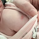 바른키움소아청소년과의원 | 신생아 BCG 예방접종 피내용vs경피용 비교, 시흥 피내접종 병원 공유 &amp; 3개월 경과 후기