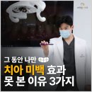 경기광주치과추천 그 동안 나만 치아 미백 효과 못 본 이유 3가지
