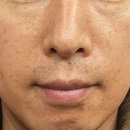 둔산송도외과 | [내돈내산] 남자 피부관리 토닝후기(feat. 효과, 통증, 주의사항)