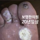 박찬한의원 | 발바닥 사마귀에 초기 티눈 냉동치료 제거했다가 아기가 재발되어 낭패본 후기.