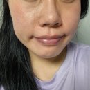 [구디피부과]포텐자콜라스터 비포, 에프터 효과 비교하기 솔직후기