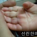 선린한의원 | (선린한의원) 손가락 화상치료 후기입니다.