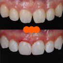 더미인의원 | 앞니 벌어짐 레진 비니어 후 미인대회 출전