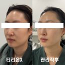 뷰티콜라겐대구지사 | [대구 리프팅] 온다리프팅? 아미뷰티센터 '온쎄라' 15만줄로 탄력 윤곽 밀착 케어