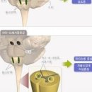 다계통 위축증이란? 증상 원인 파킨슨 차이 이미지