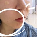 나비성형외과의원 | 강남역스킨보톡스: 턱라인 스킨보톡스 전후 후기