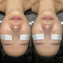 배다리어린이집 | 평택 비전동 피부관리 모은에스테틱에서 블랙헤드 모공케어