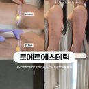 마산회원구 ⓒ-20 | 마산에스테틱 로에르에스테틱｜팔뚝관리 5회 최종 후기