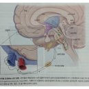 일차두통 증후군 - 편두통 이미지